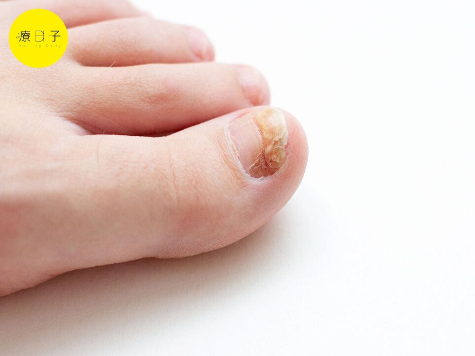 治療灰指甲最好辦法 灰指甲治療 