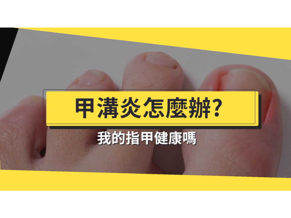 甲溝炎治療 甲溝炎怎麼辦