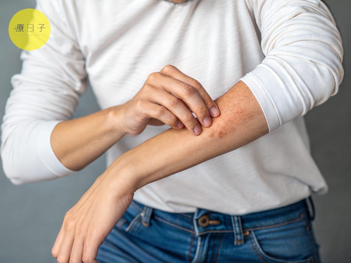 春夏交替濕氣重！濕疹調養如何做？中醫師：內外調養 預防復發