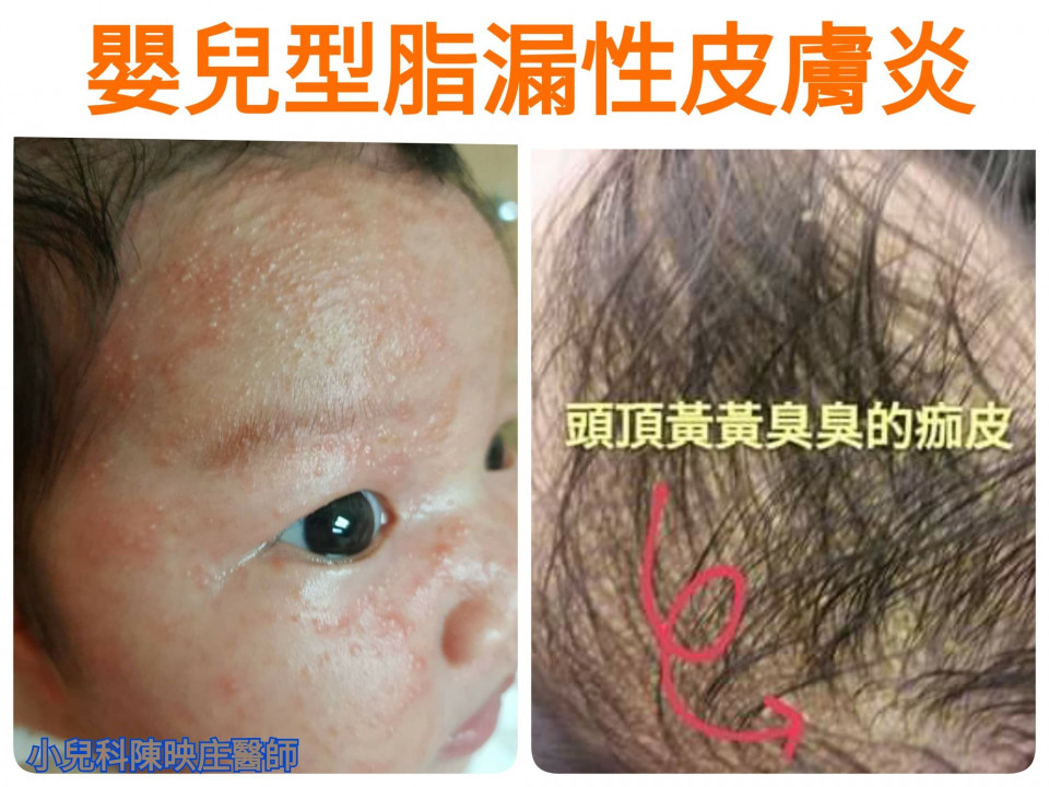 脂漏性皮膚炎