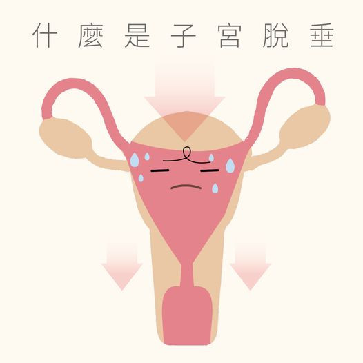 什麼是子宮脫垂