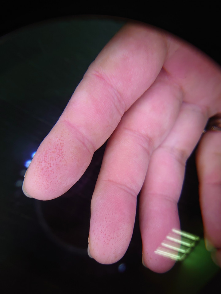 汗皰疹治療 照片