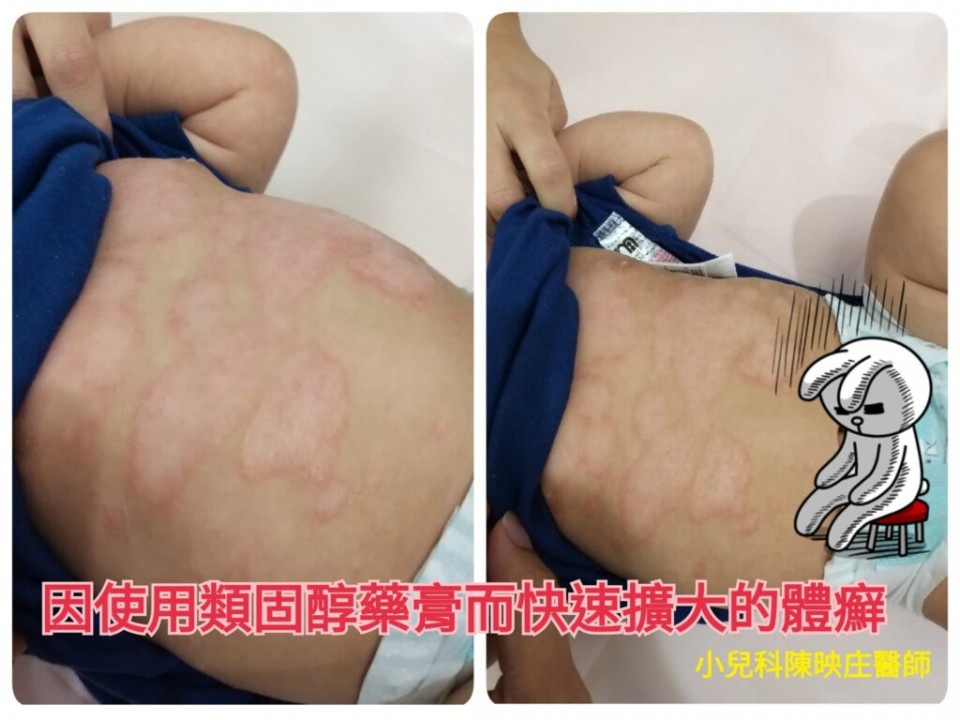 體癬
