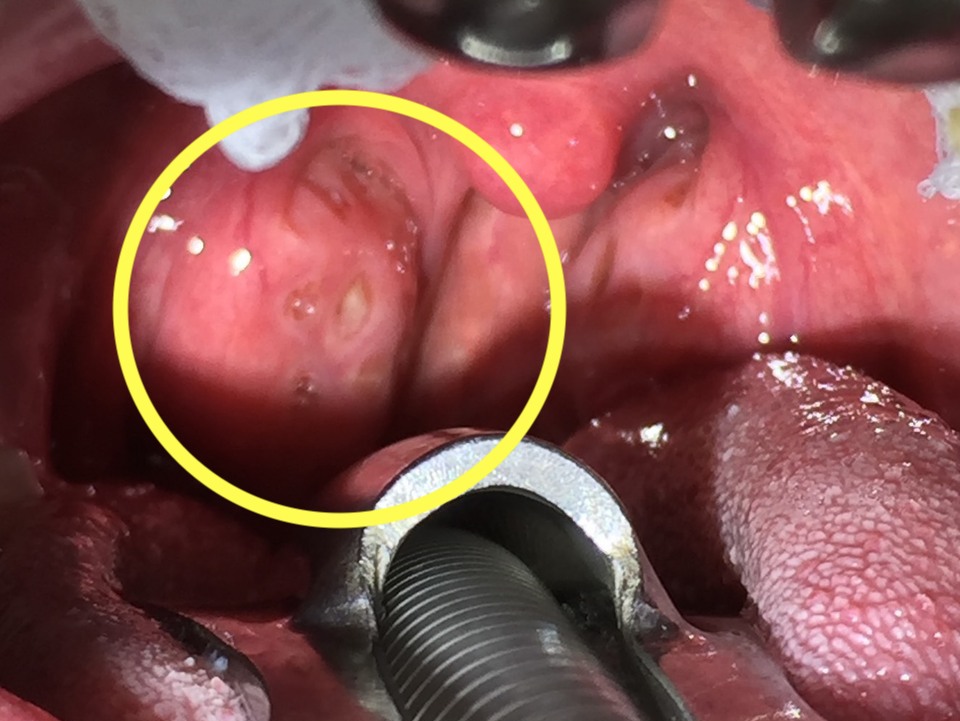 扁桃腺結石照片