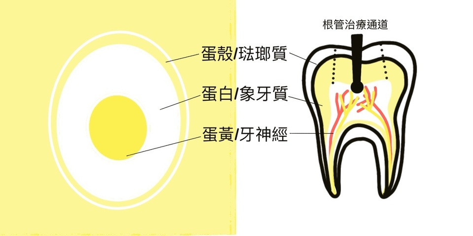 根管治療