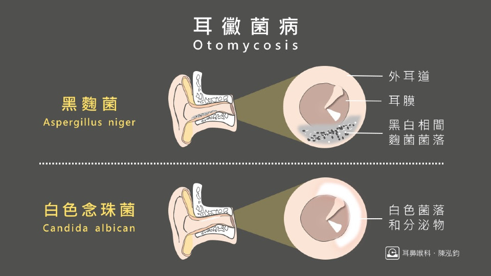 耳朵黴菌 耳朵發霉原因