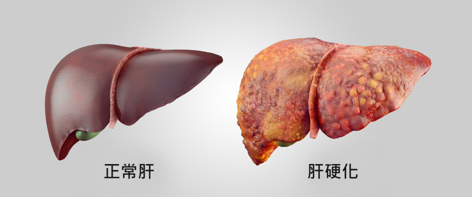 肝硬化症狀