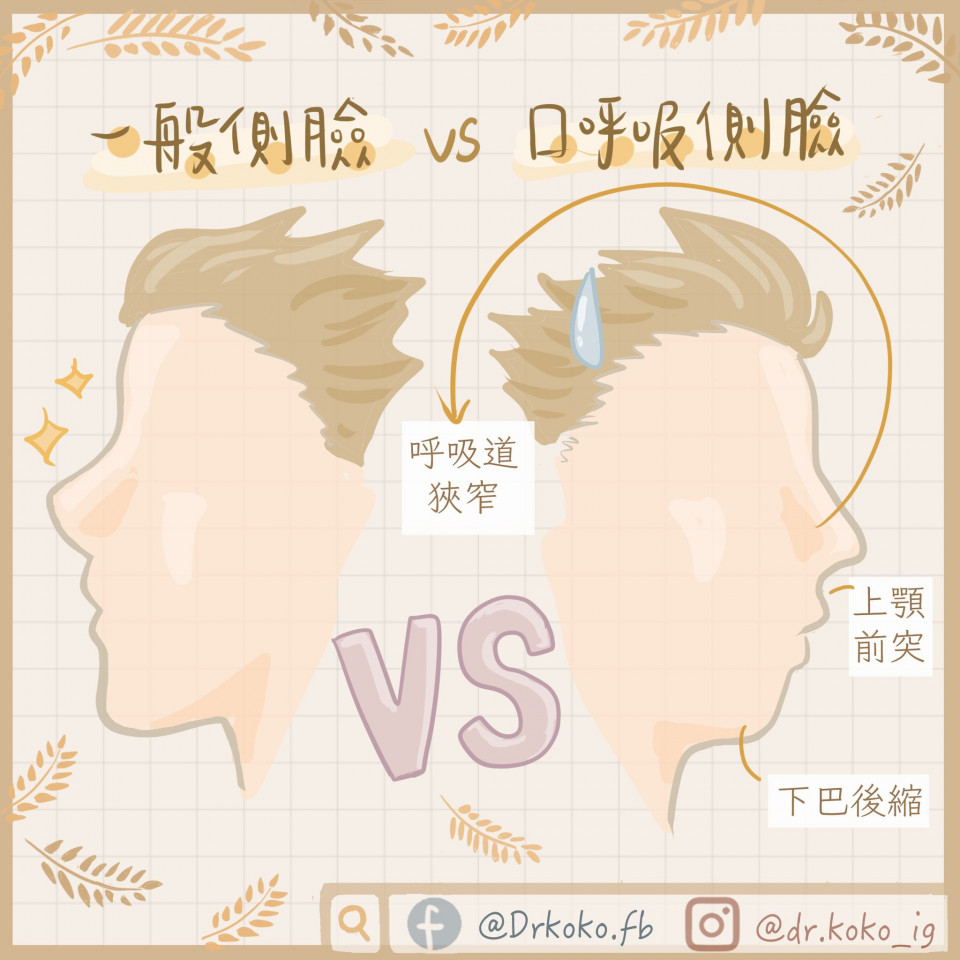口呼吸致臉變形