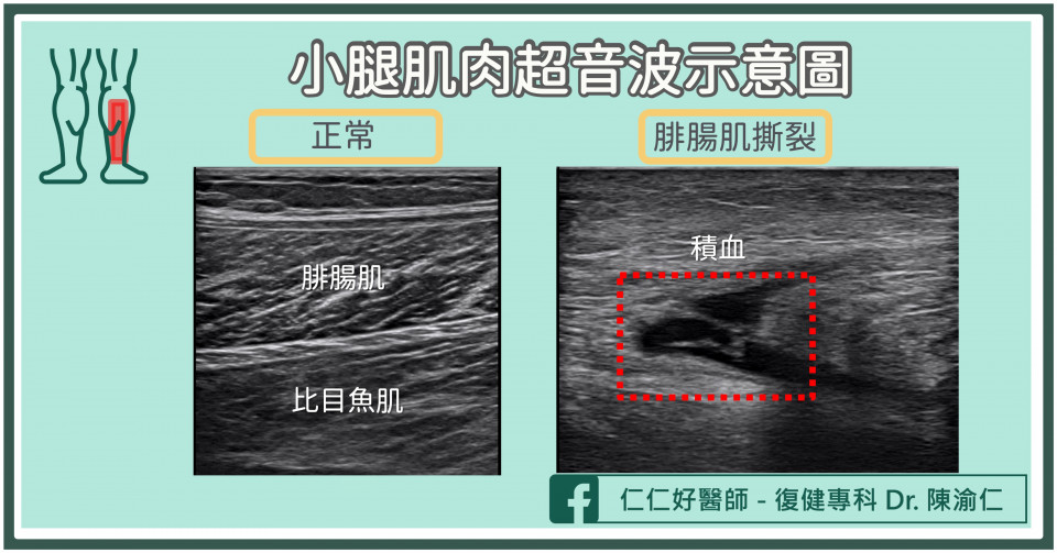超音波照