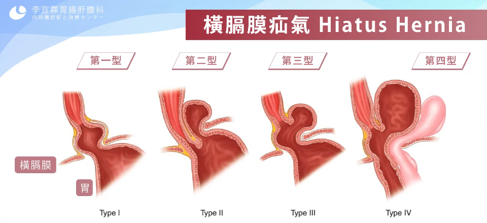 橫隔膜疝氣
