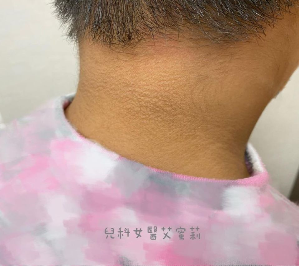 黑色棘皮症 症狀 原因