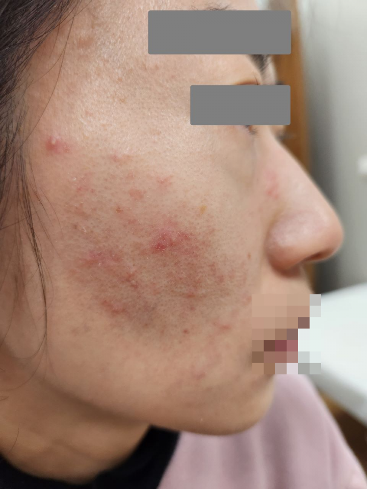 蠕形蟎蟲症狀
