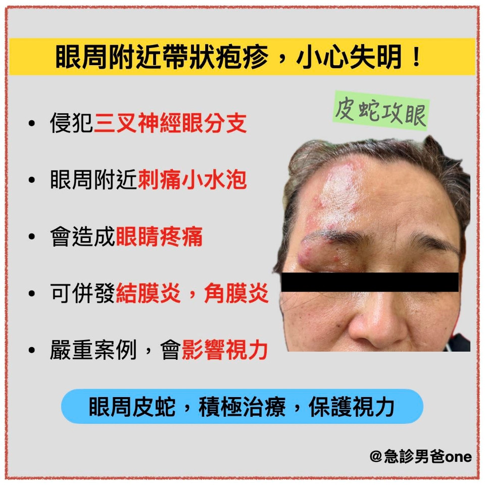 臉部、眼周 帶狀皰疹症狀