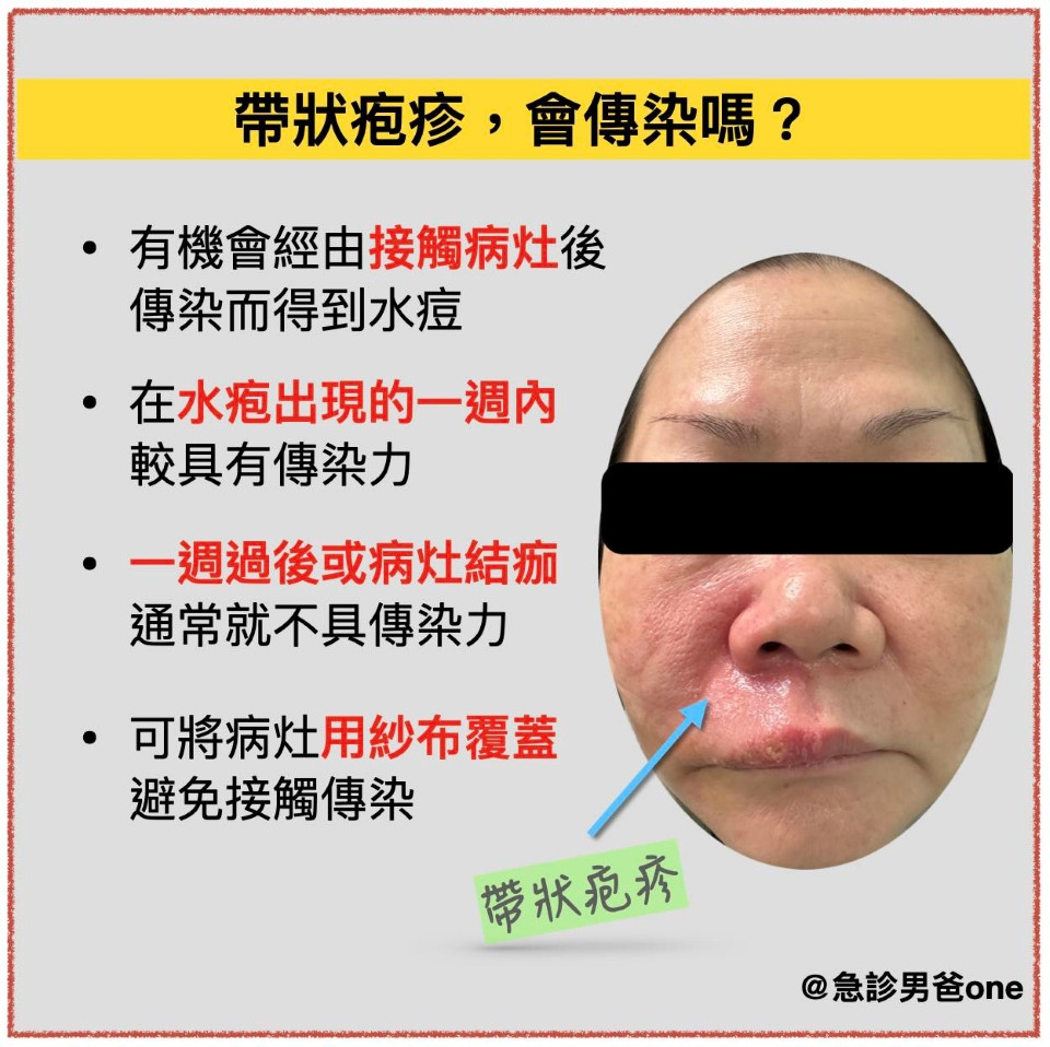 帶狀皰疹會傳染嗎