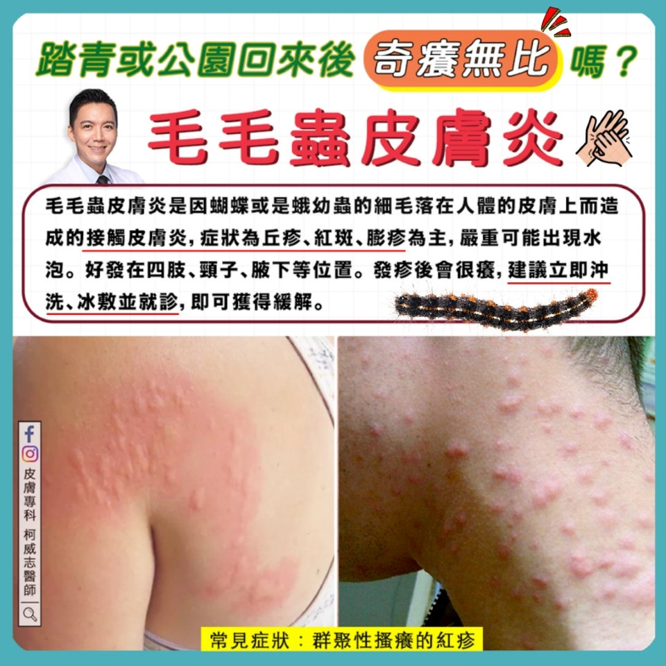 毛毛蟲皮膚炎症狀