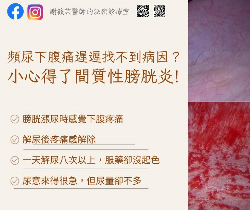 間質性膀胱炎