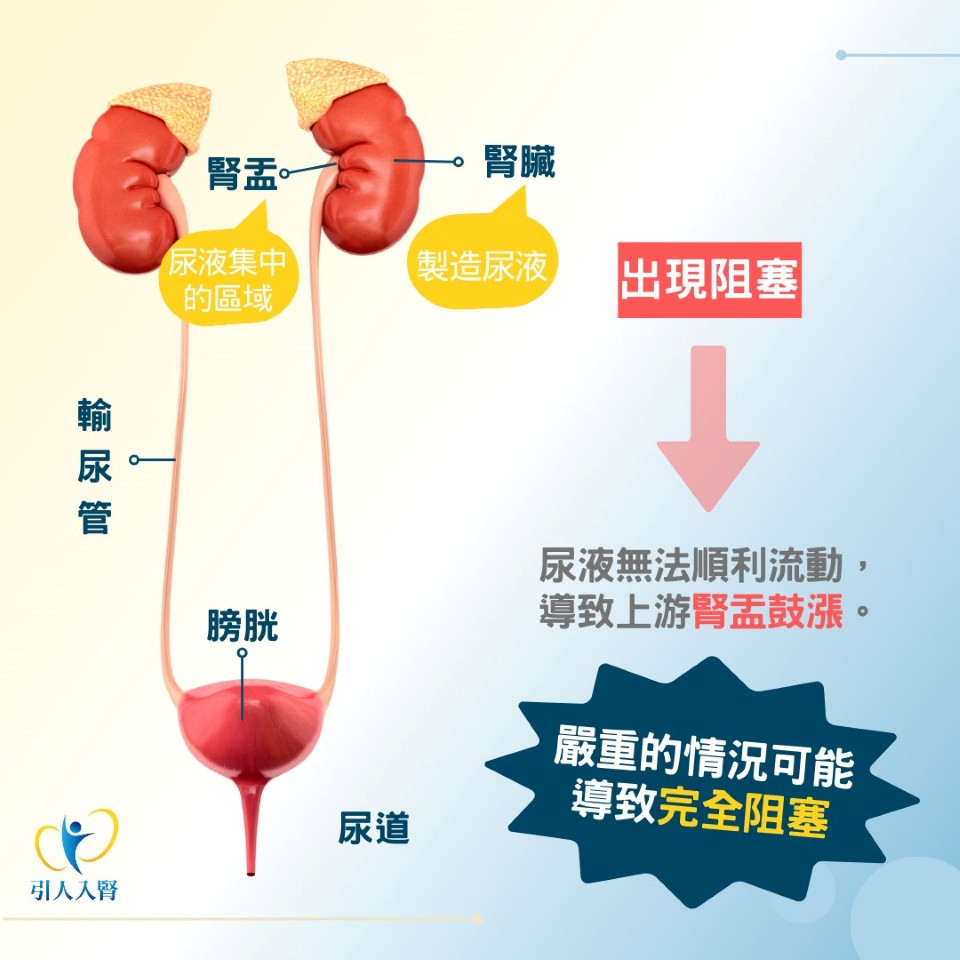 水腎原因